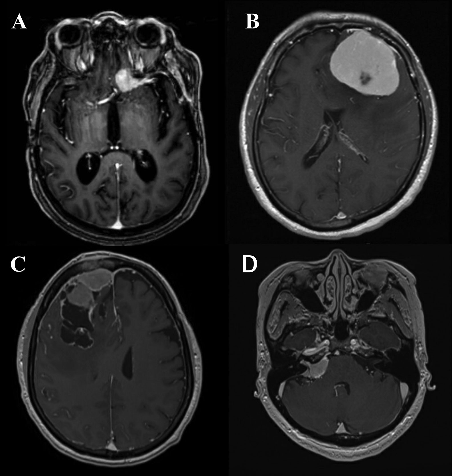 Rubinstein-Taybi syndrome  Radiology Reference Article