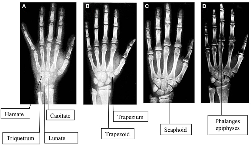 Frontiers  Evaluation of Bone Age in Children: A Mini-Review