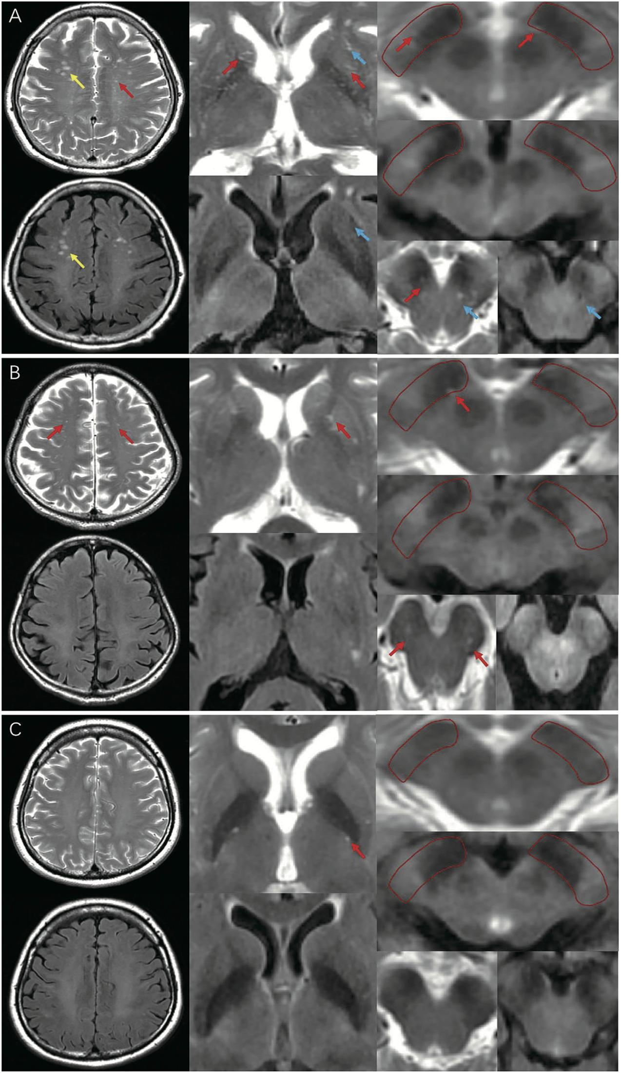 Frontiers | Different Perivascular Space Burdens in Idiopathic Rapid Eye  Movement Sleep Behavior Disorder and Parkinson's Disease
