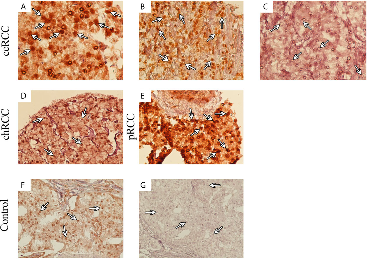 Frontiers | SMAD4 Expression in Renal Cell Carcinomas Correlates Frontiers | SMAD4 Expression in Renal Cell Carcinomas Correlates
