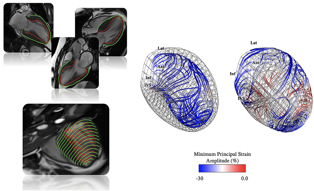 2- and 3-Dimensional Myocardial Strain in Cardiac Health and Disease