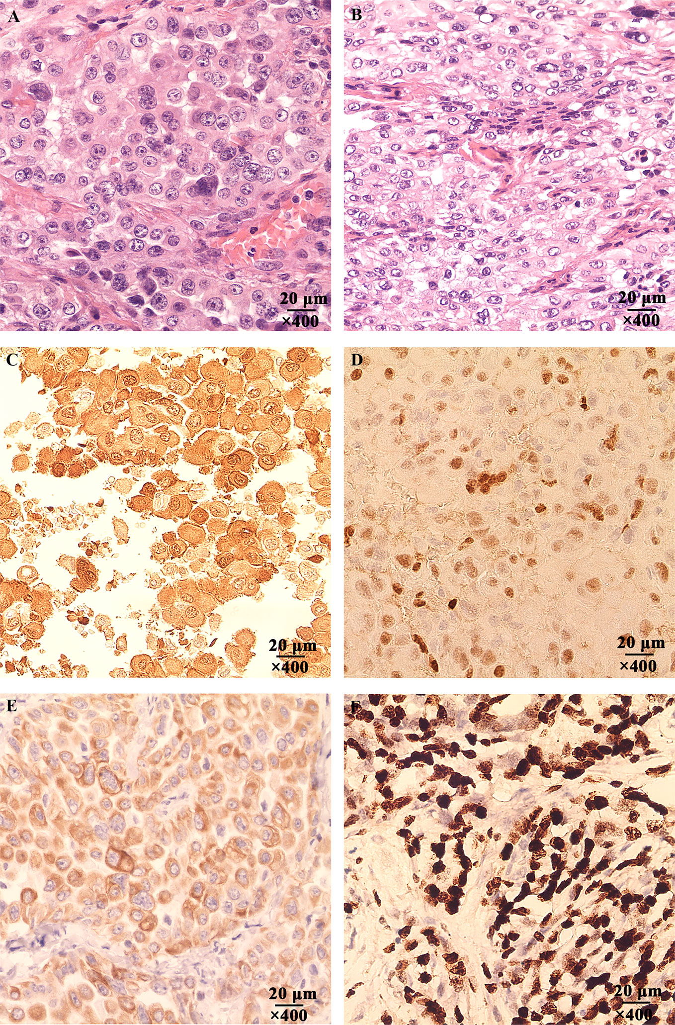 does radiation for breast cancer cause diarrhea