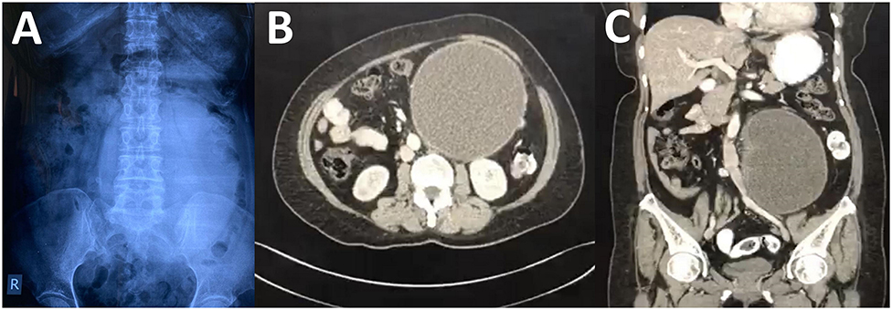 how long can someone survive stage 4 lung cancer