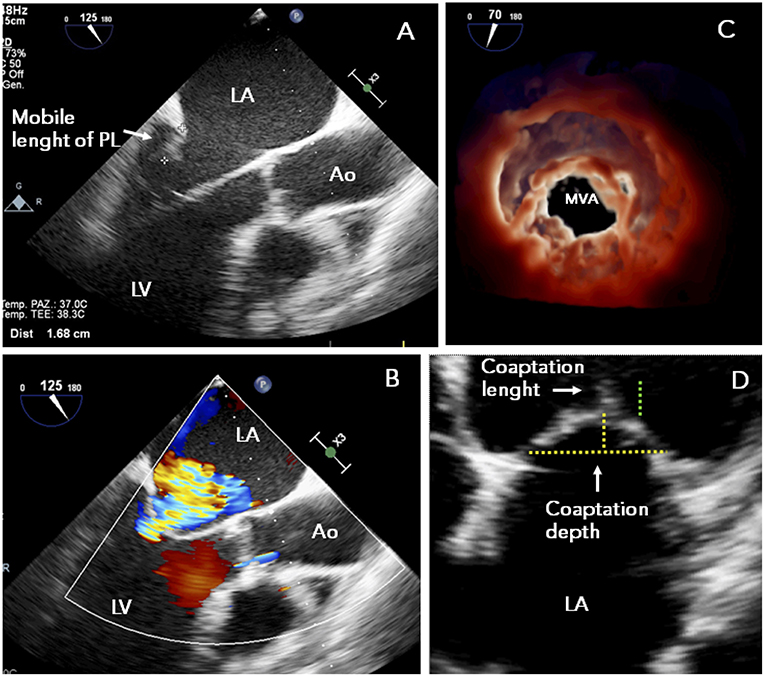 Hypokinesis, Mitral Regurgitation, Aortic Insufficiency 