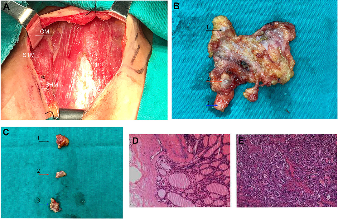 Frontiers Subcutaneous Recurrences Of Thyroid Cancer After