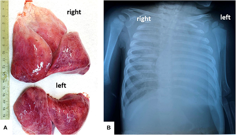 Covid lungs after Improving Lung