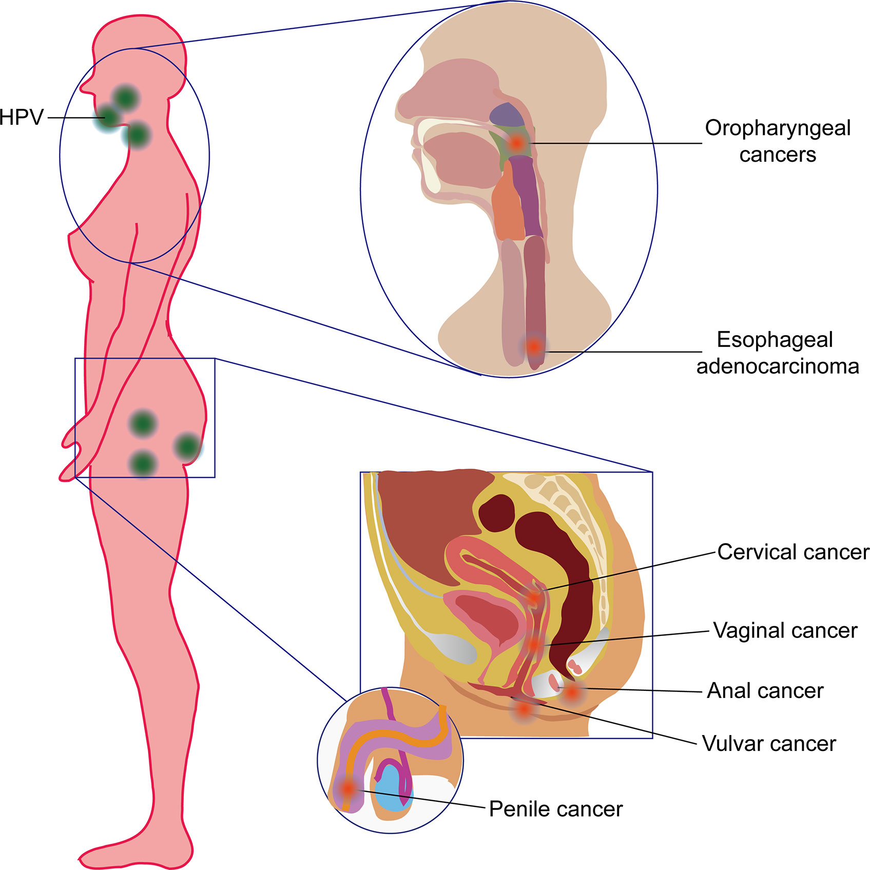 hpv causes esophageal cancer)