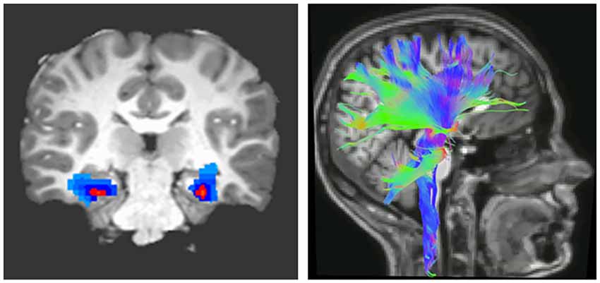 anxiety disorder brain