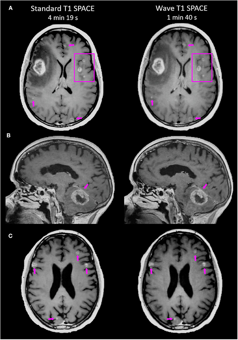 | Accelerated Post-contrast Wave-CAIPI T1 SPACE Achieves Equivalent Diagnostic Performance Compared With Standard T1 SPACE for the Detection of Brain Metastases Clinical 3T MRI