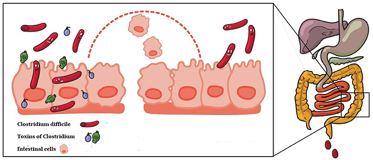 Figure 1 - C. difficile secretes toxins that damage the intestinal lining.