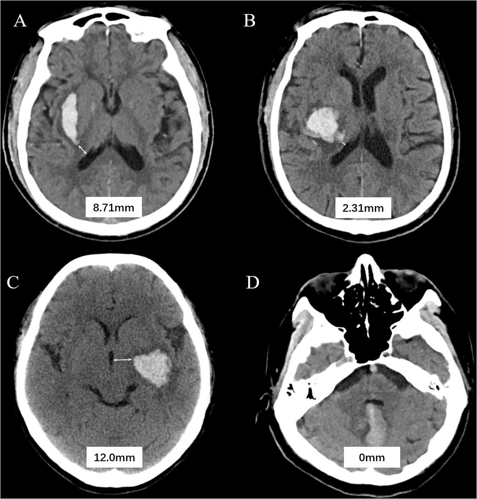 Brain Hemorrhage Scan