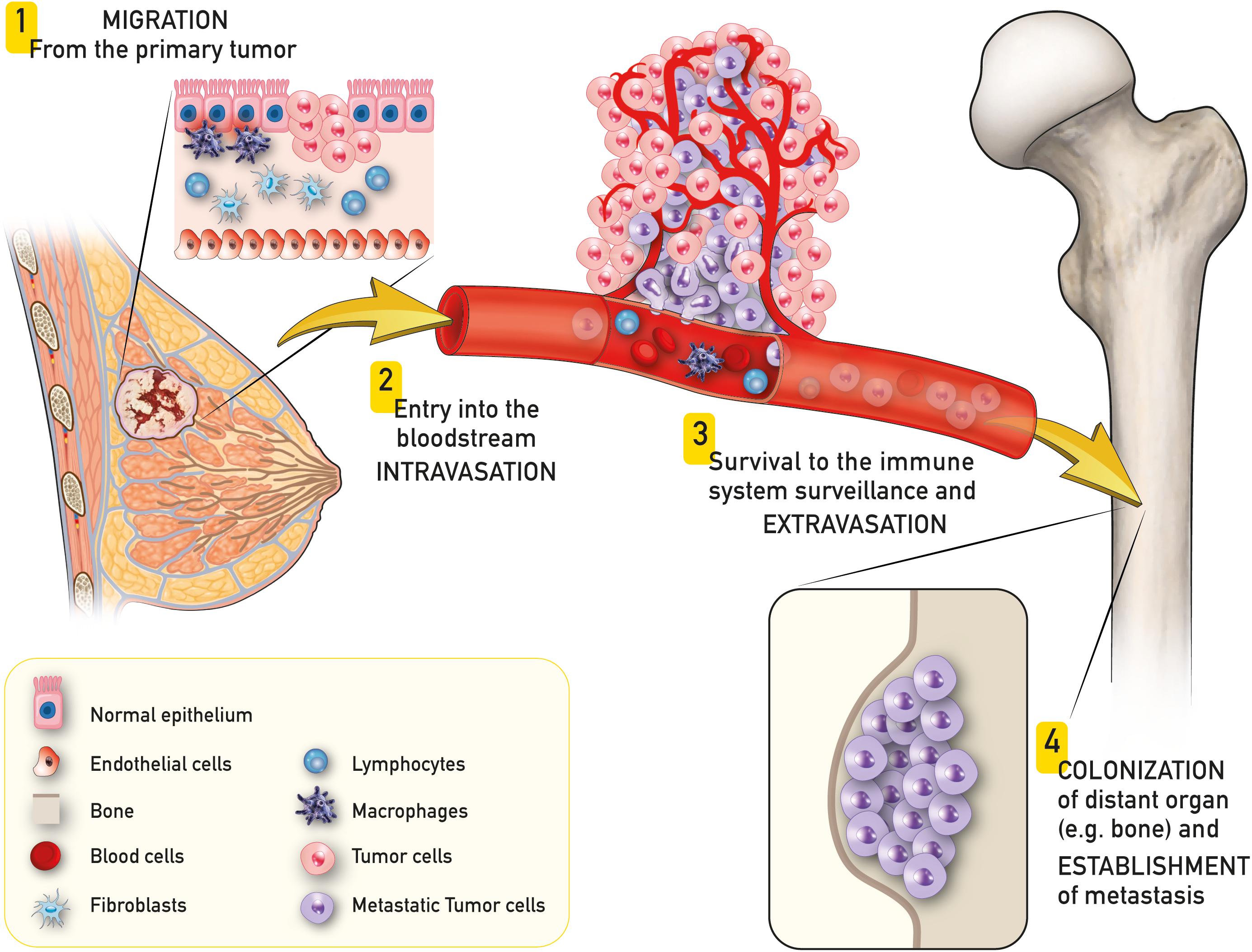 Metastatic cancer bone