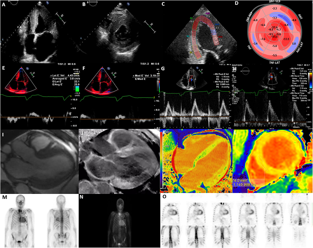 Frontiers  Multi-Modality Imaging in Dilated Cardiomyopathy: With a Focus  on the Role of Cardiac Magnetic Resonance