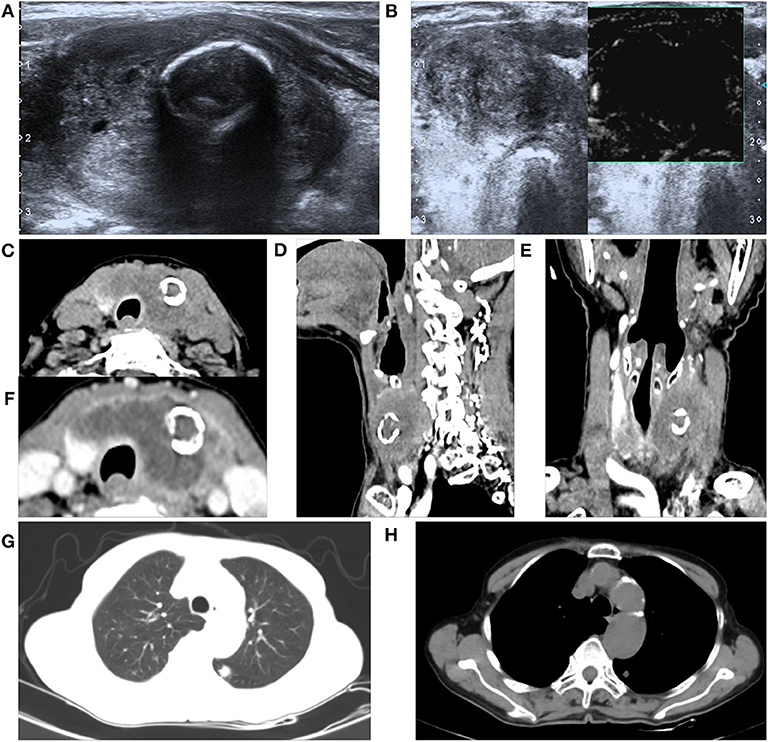 Frontiers A Primary Squamous Cell Carcinoma Of The Thyroid Presenting