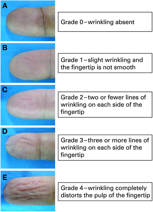 wrinkles Deep thyroid facial