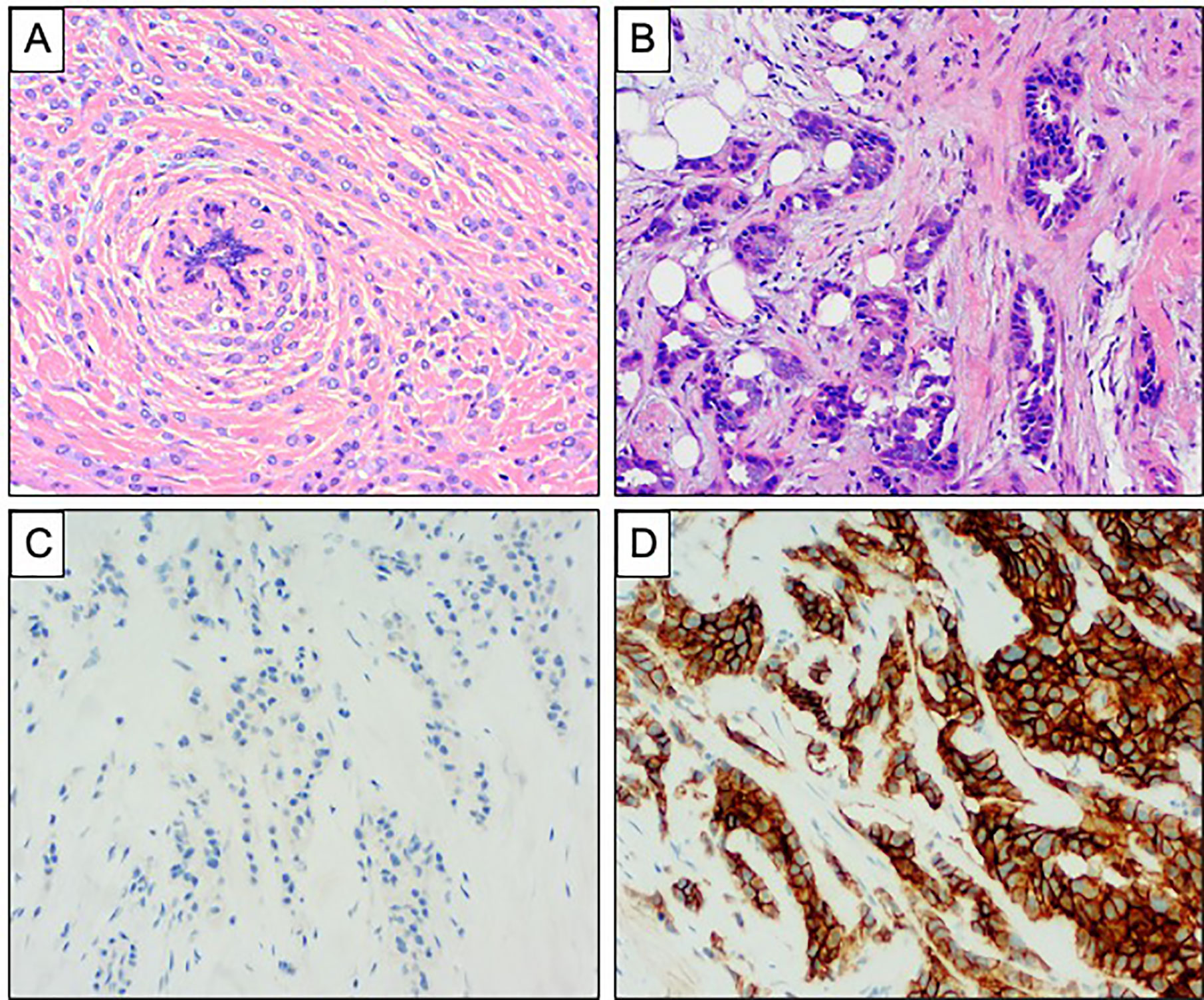 Frontiers Lobular Breast Cancer A Review Oncology