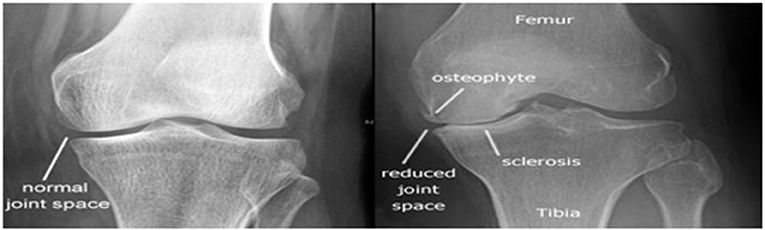 osteoarthritis knee imaging)