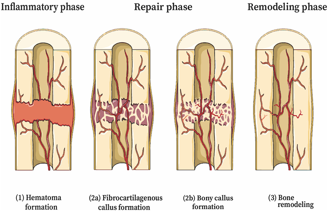 Self-powered implantable device stimulates fast bone healing, then