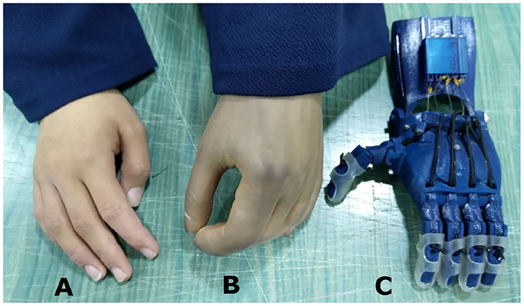 Frontiers  Suitability of the Openly Accessible 3D Printed Prosthetic  Hands for War-Wounded Children
