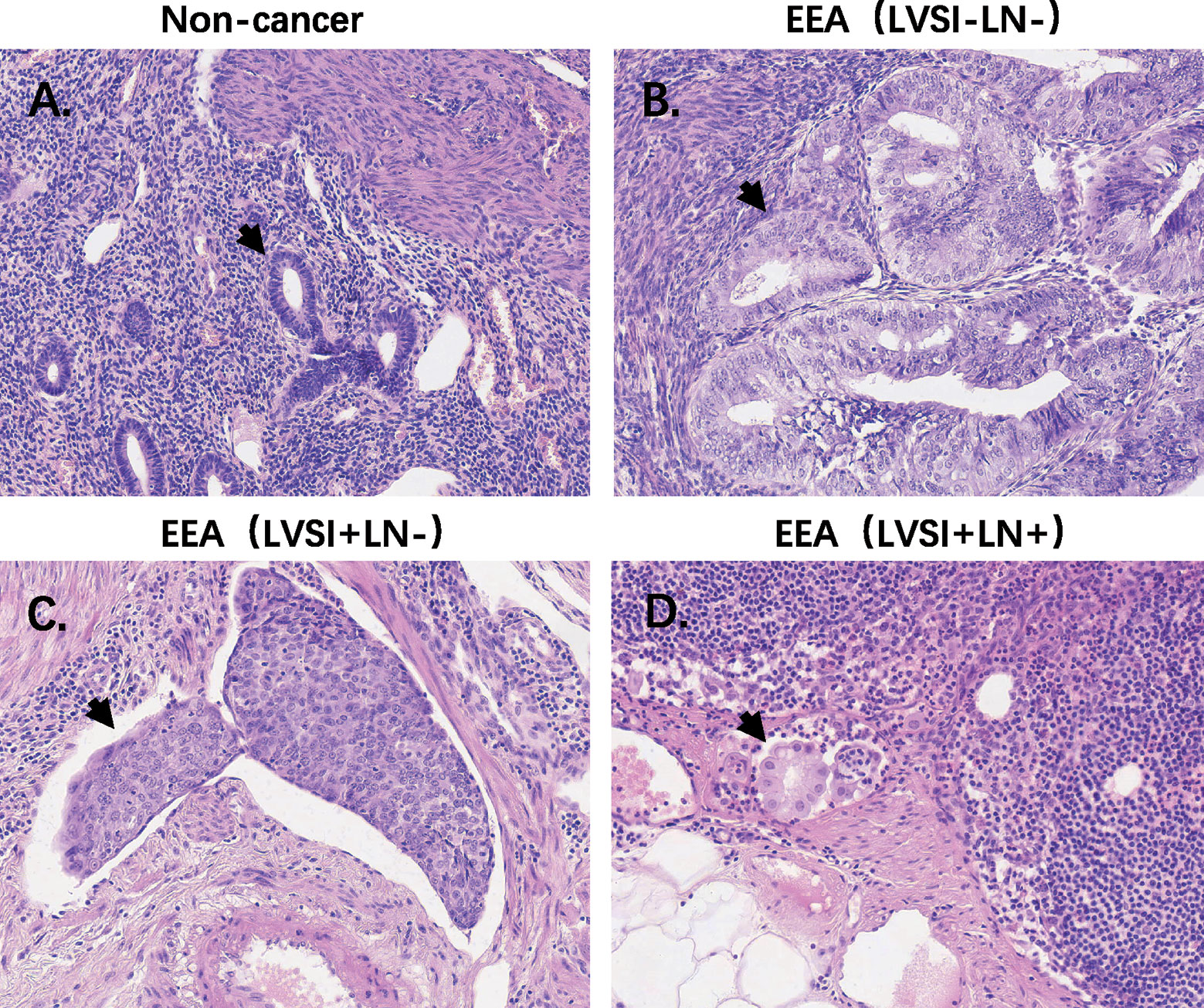 Frontiers Reconstruction Of Immune Microenvironment And Signaling Pathways In Endometrioid Endometrial Adenocarcinoma During Formation Of Lymphovascular Space Involvement And Lymph Node Metastasis Oncology