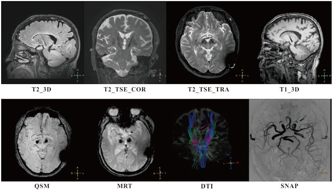 PDF) Tractographical model of the cortico-basal ganglia and corticothalamic  connections: Improving Our Understanding of Deep Brain Stimulation