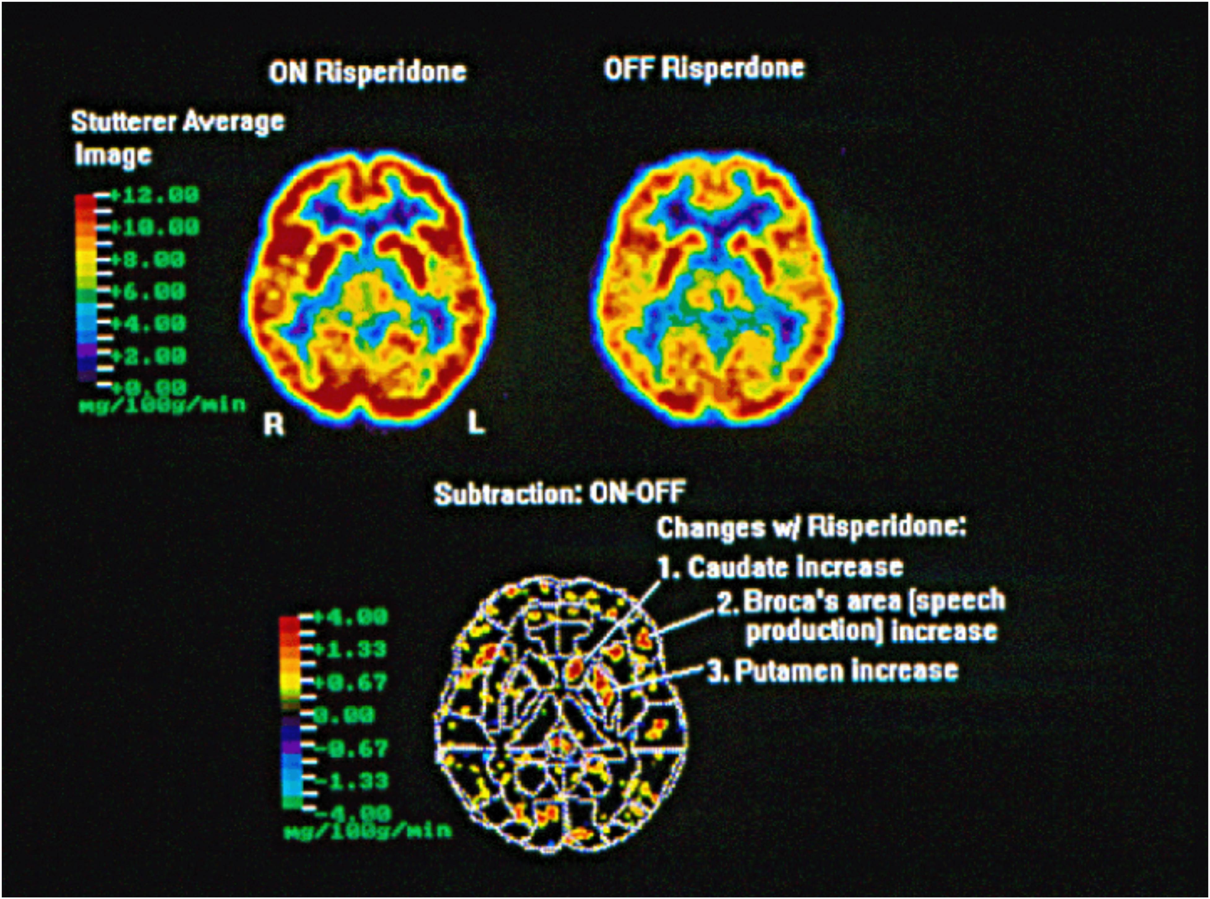 Finally a brain test showed which medications would help. - The  NeuroDevelopment Center