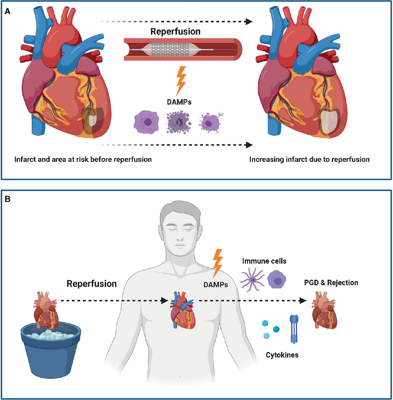 What Is Myocardial Infarction - vrogue.co