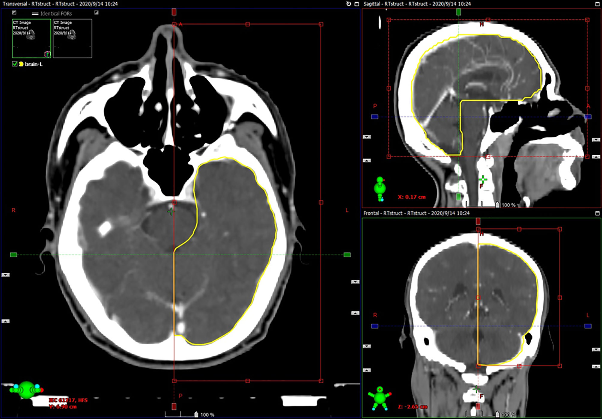Impact of Neuroradiology-Based Peer Review on Head and Neck Radiotherapy  Target Delineation
