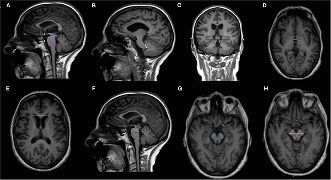 Frontiers Association of MRI Measures With Severity and Progression Supranuclear Palsy