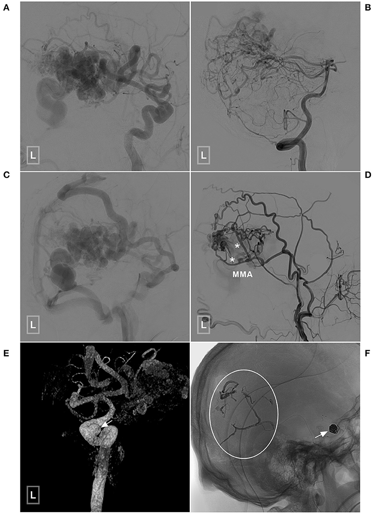 Atlas of Operative Microneurosurgery, Volume 1: Aneurysms