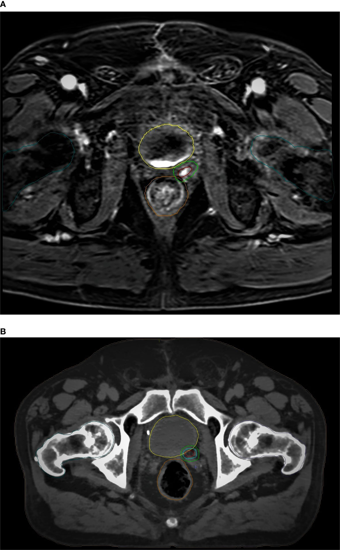 Surgical clips -Mammogram shows linear radiopaque clips, placed during