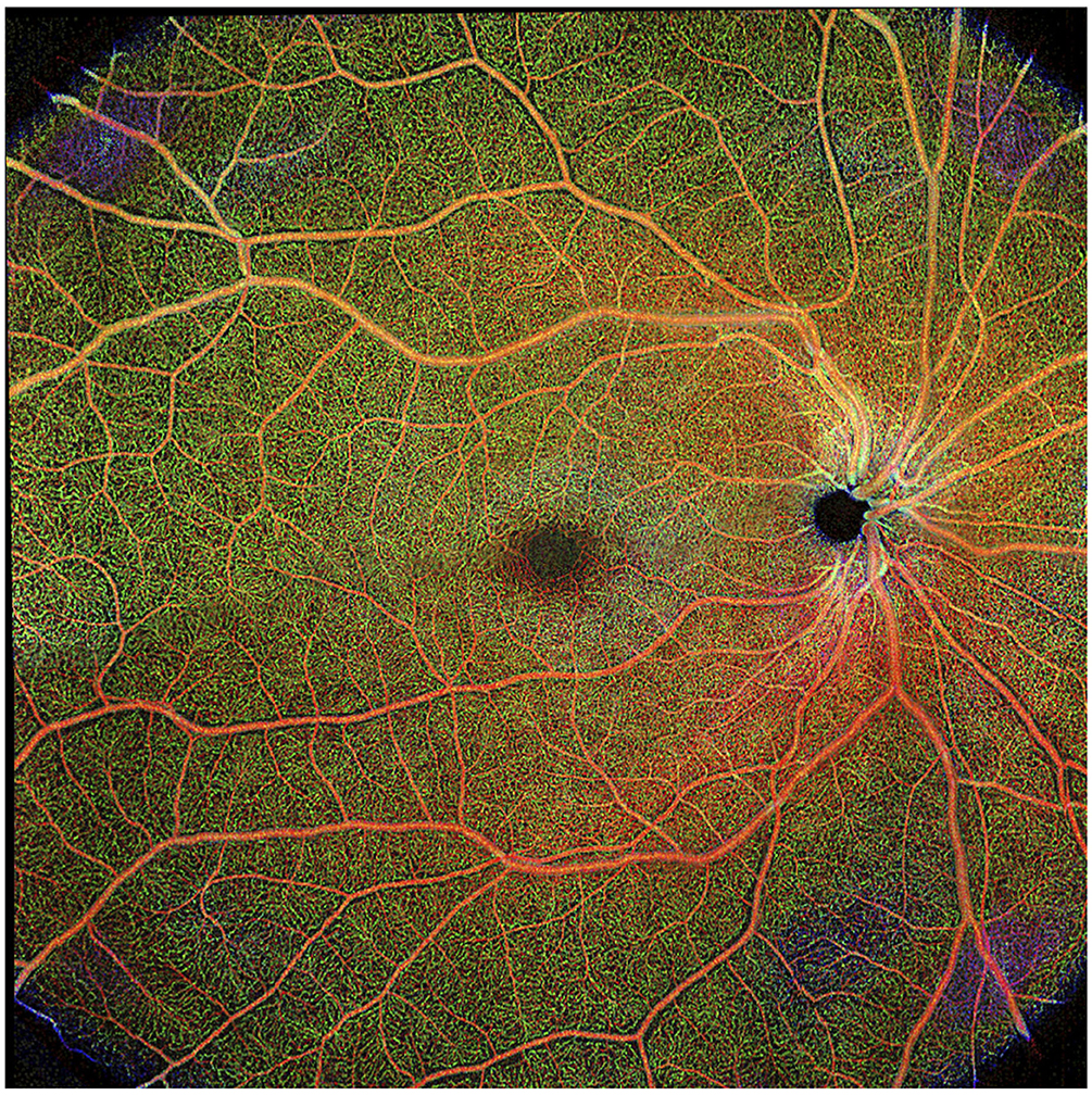 Altered ocular microvasculature in patients with systemic sclerosis and very early disease of systemic sclerosis using optical coherence tomography angiography