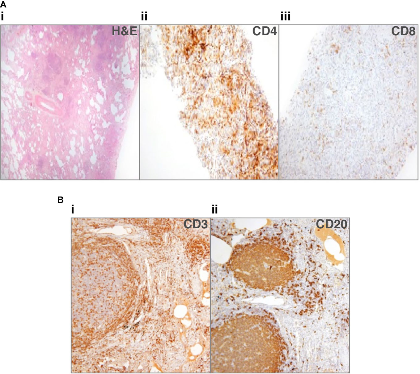 Interstitial Lung Disease Histology