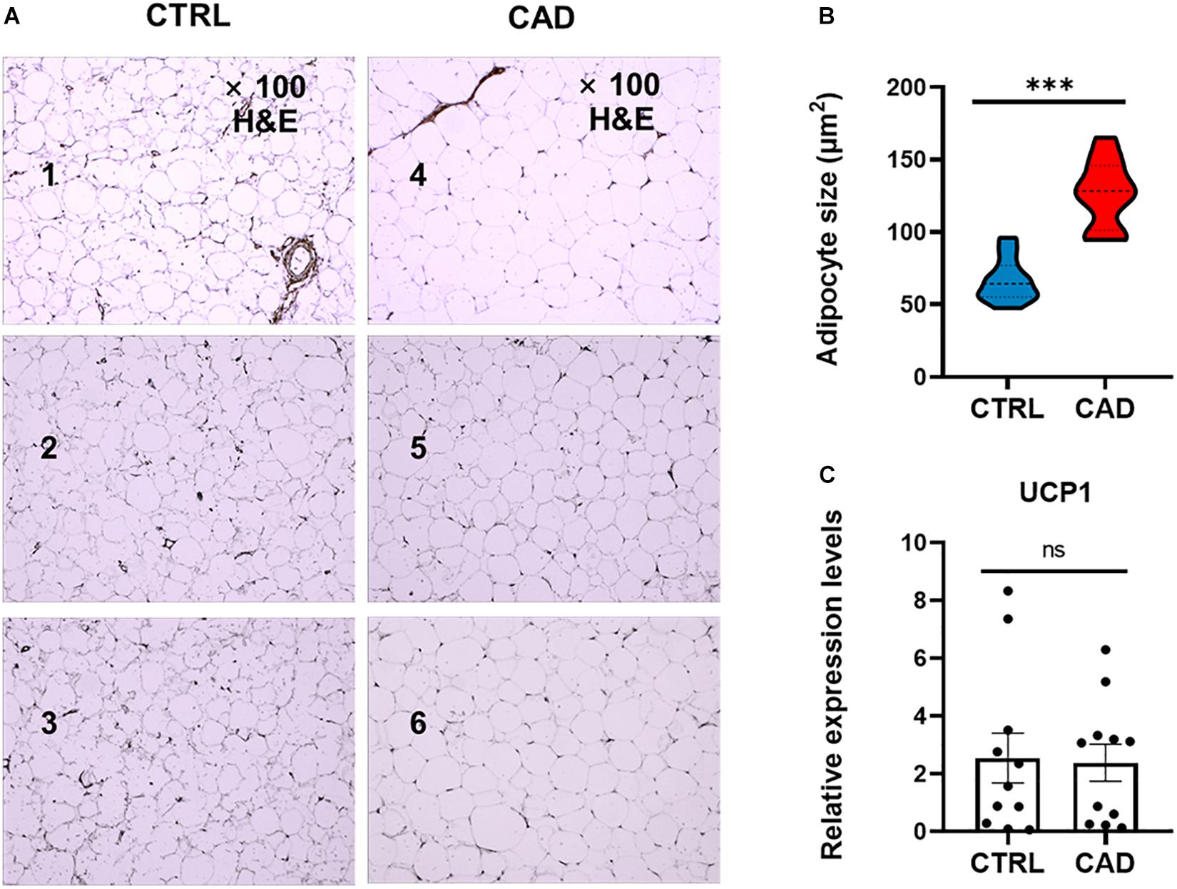 Frontiers  Deleterious Effects of Epicardial Adipose Tissue