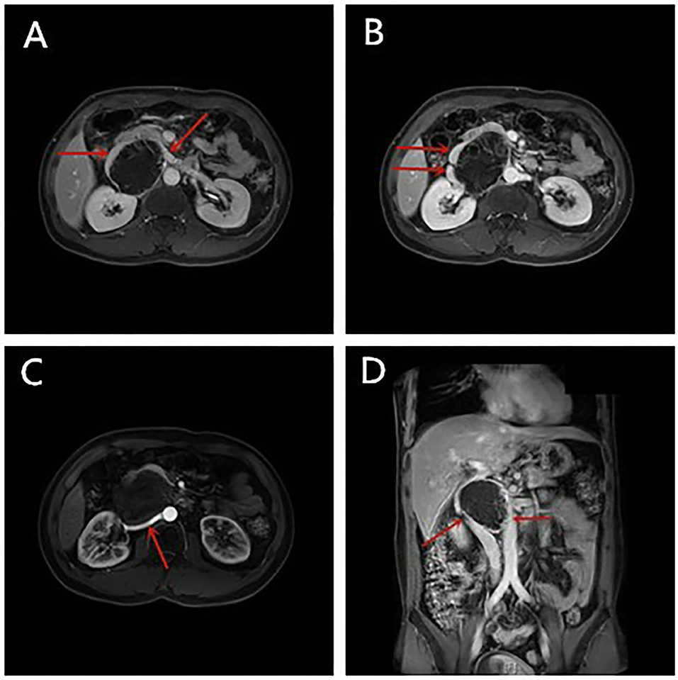 Sudden onset flank pain: a case report of retroperitoneal hemorrhage s