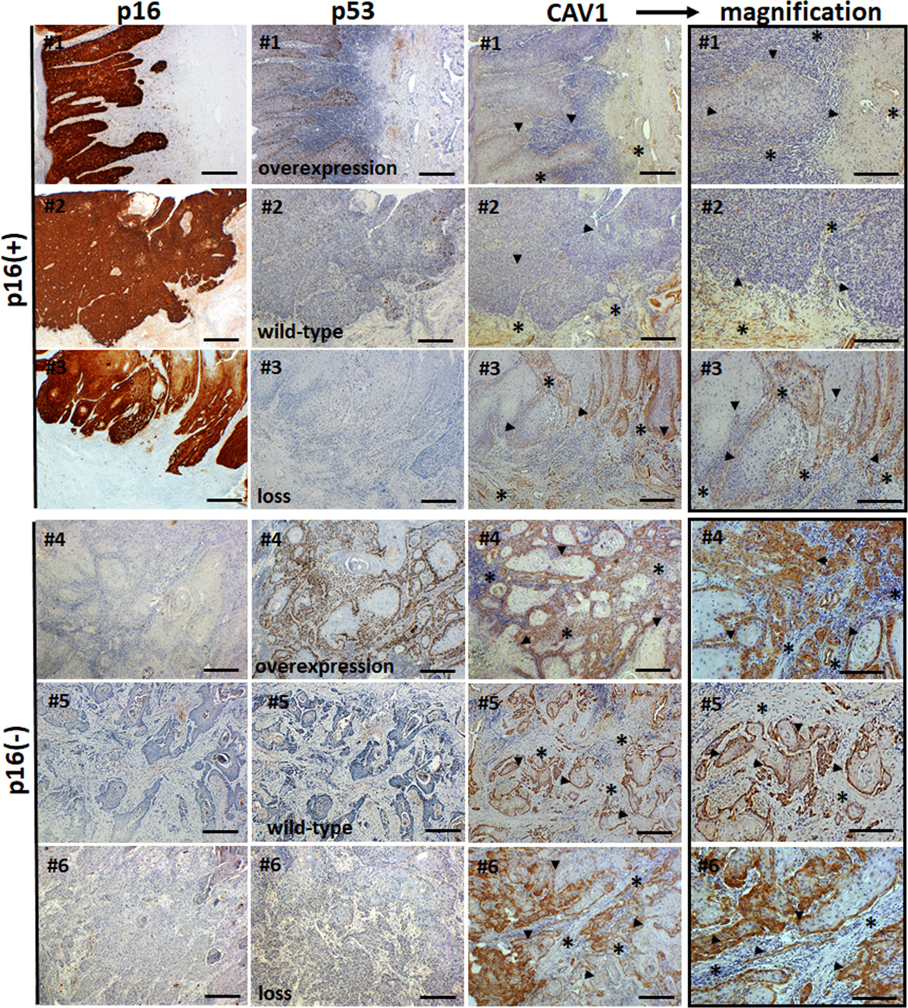 Oncologie condiloame