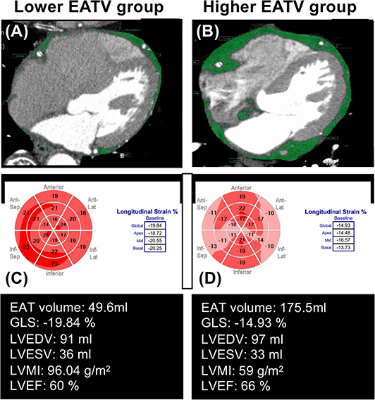 Left ventricular global strains by linear measurements in three