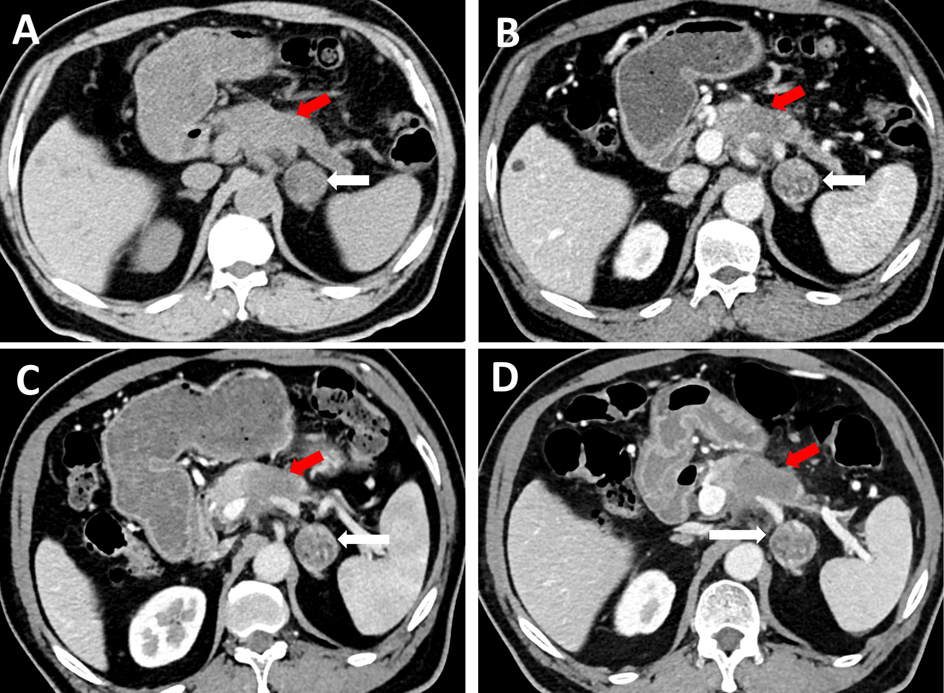 Frontiers | An Unexpected Case Report of Adrenal Lymphangioma: Mimicking Metastatic Tumor on Imaging in a Patient With Pancreatic Cancer Frontiers | An Unexpected Case Report of Adrenal Lymphangioma: Mimicking Metastatic Tumor on Imaging in a Patient With Pancreatic Cancer