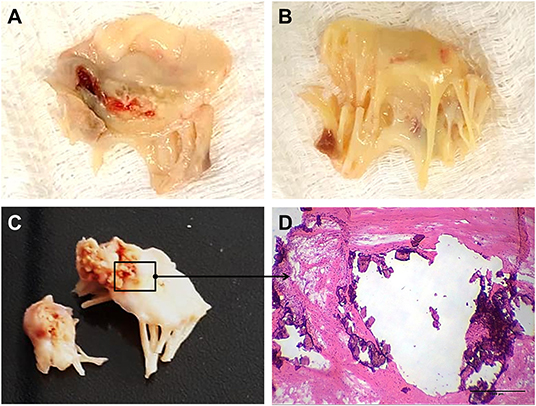 Frontiers | Rheumatic Heart Valve Disease Pathophysiology and