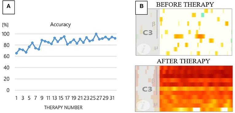 Figure 2 - (A) BCI accuracy from therapy sessions 1 through 31 for one patient.