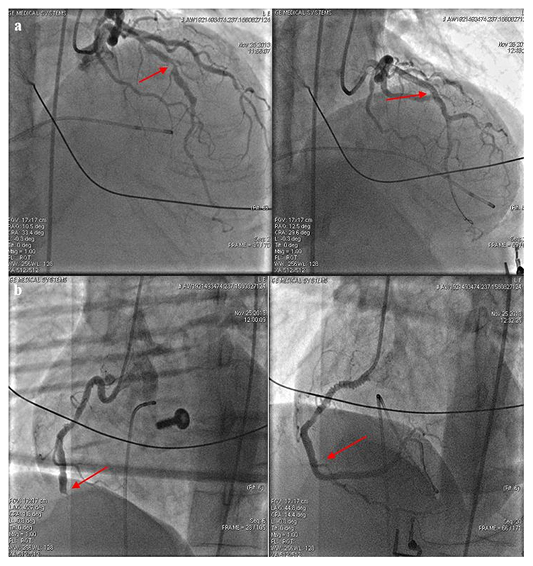 Large Randomized Trial: LUCAS Chest Compression System is Effective and  Reliable in Pre-Hospital Cardiac Arrest