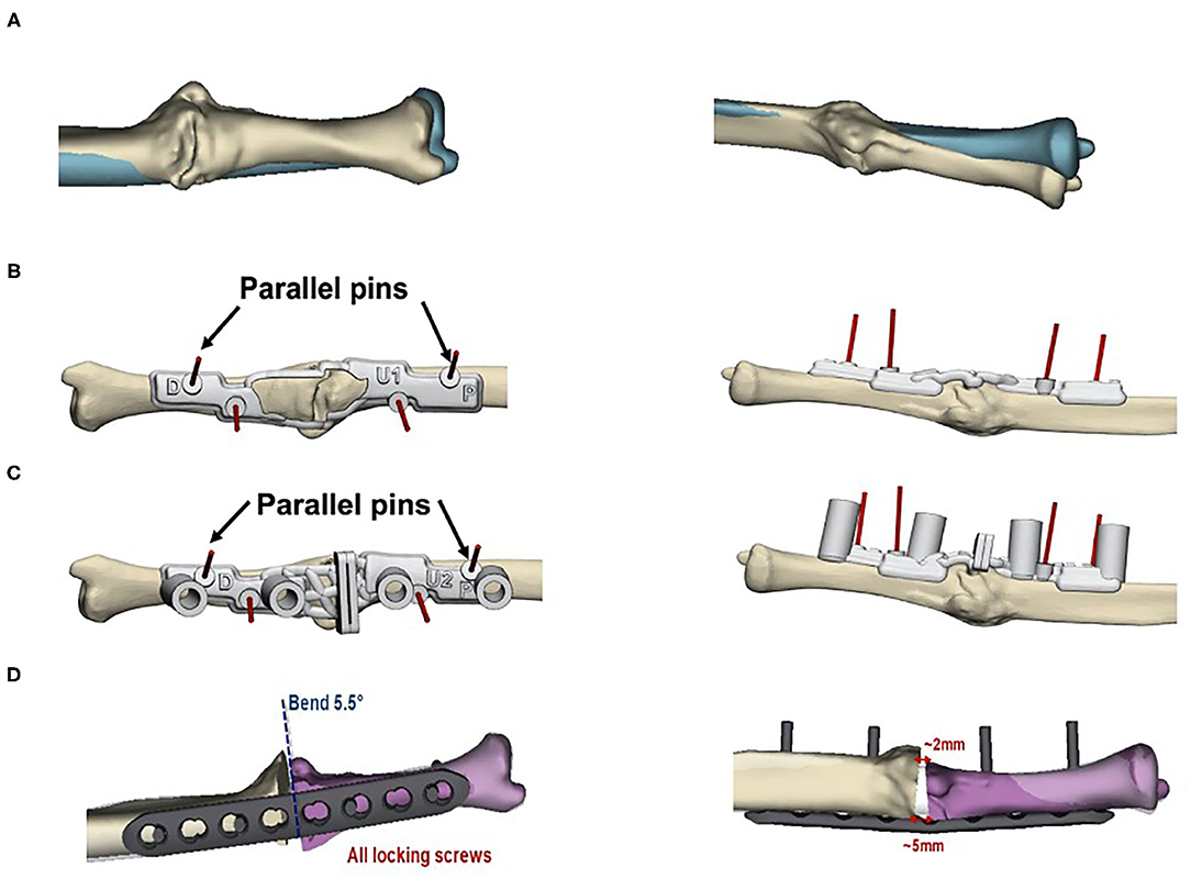 Frontiers Corrective Osteotomy Of Upper Extremity Malunions Using