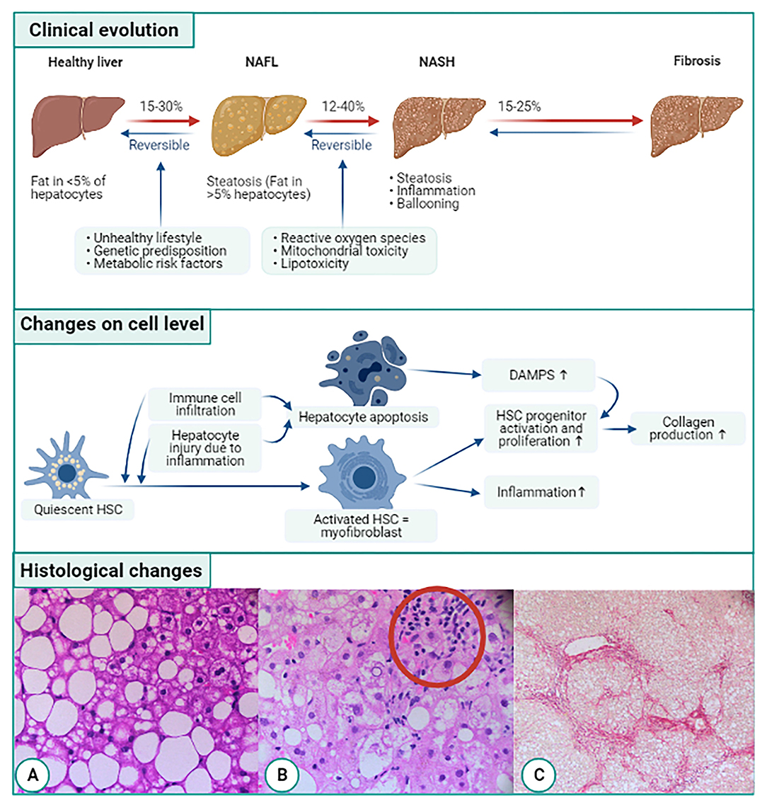 Frontiers Liver Fibrosis in Non-alcoholic Fatty Liver Disease From Liver Biopsy to Non-invasive Biomarkers in Diagnosis and Treatment
