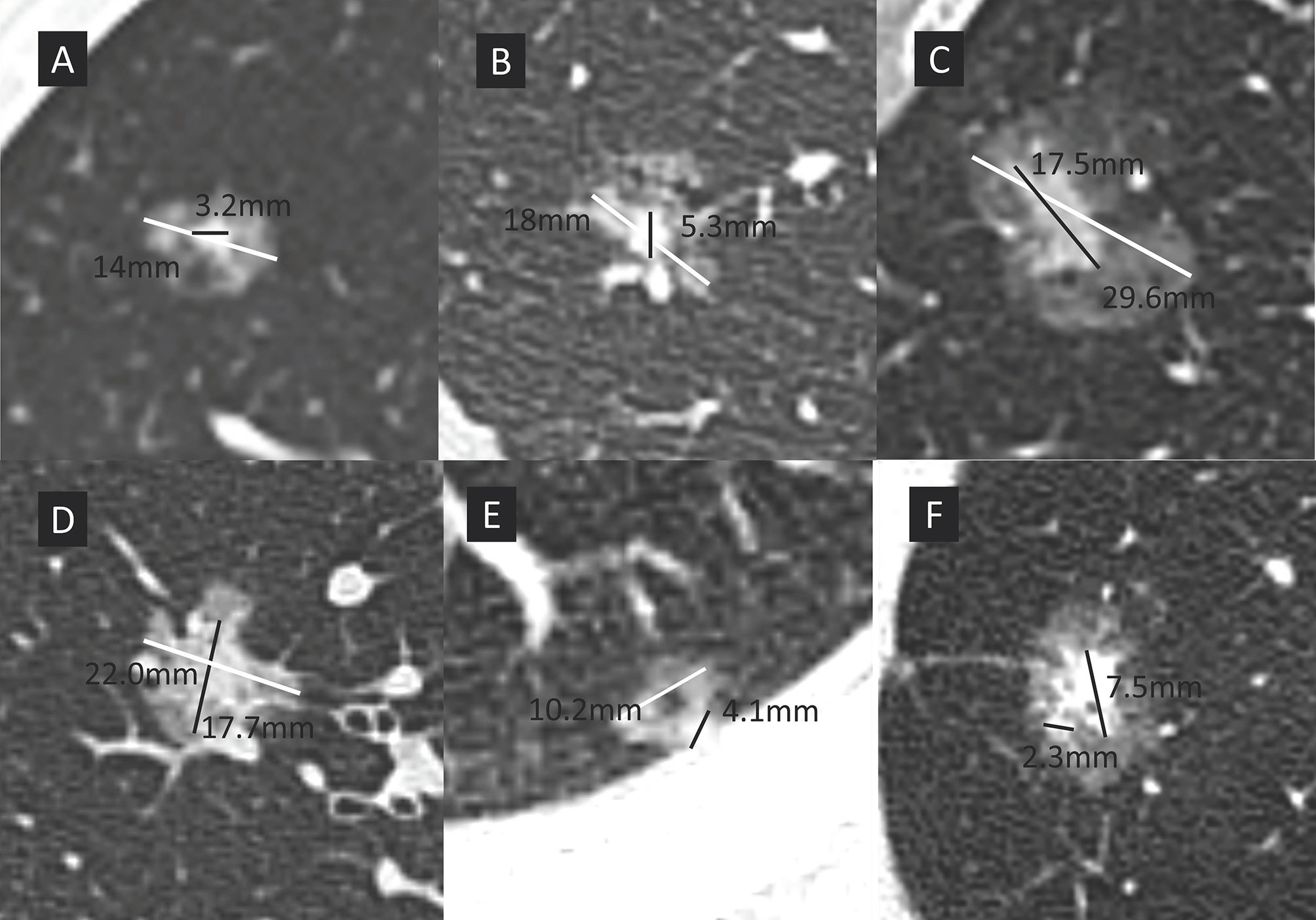 Frontiers | Prognostic Impact of Radiological Consolidation Tumor Ratio ...