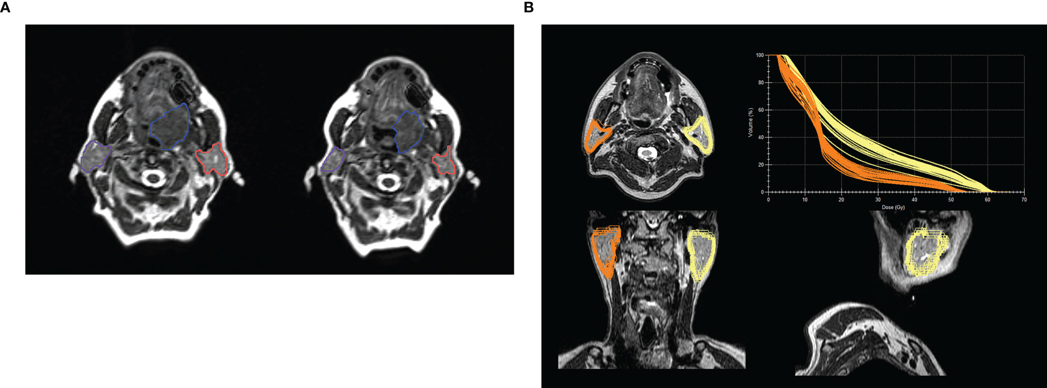 Frontiers Mr Guided Radiotherapy For Head And Neck Cancer Current