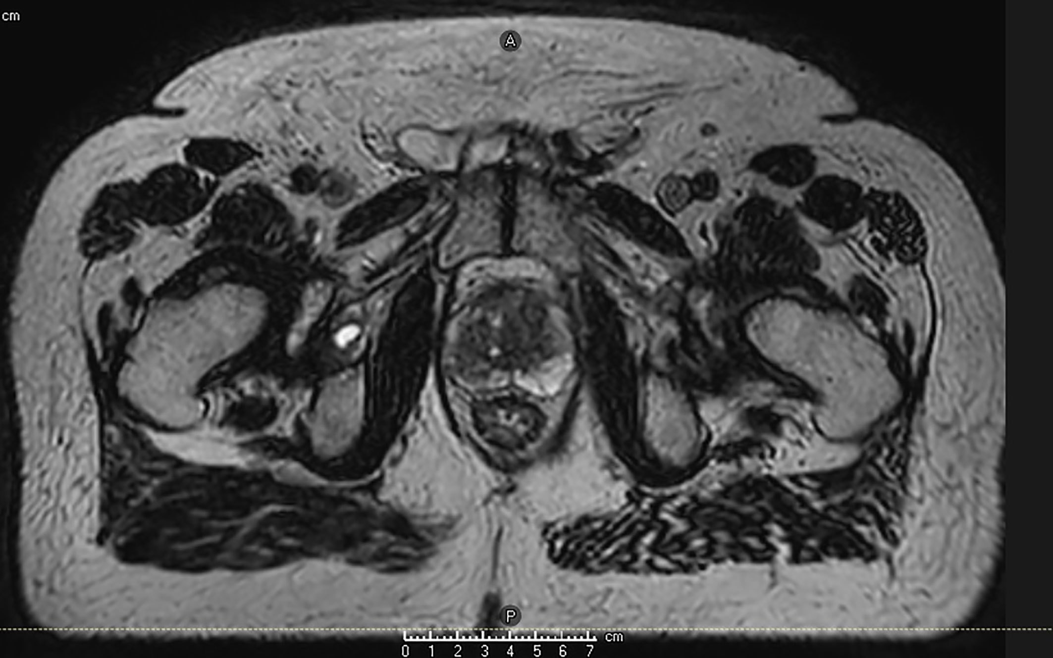 Prostatitis bacteriana caso clínico 4 Replies to “Uretroprostatitis”