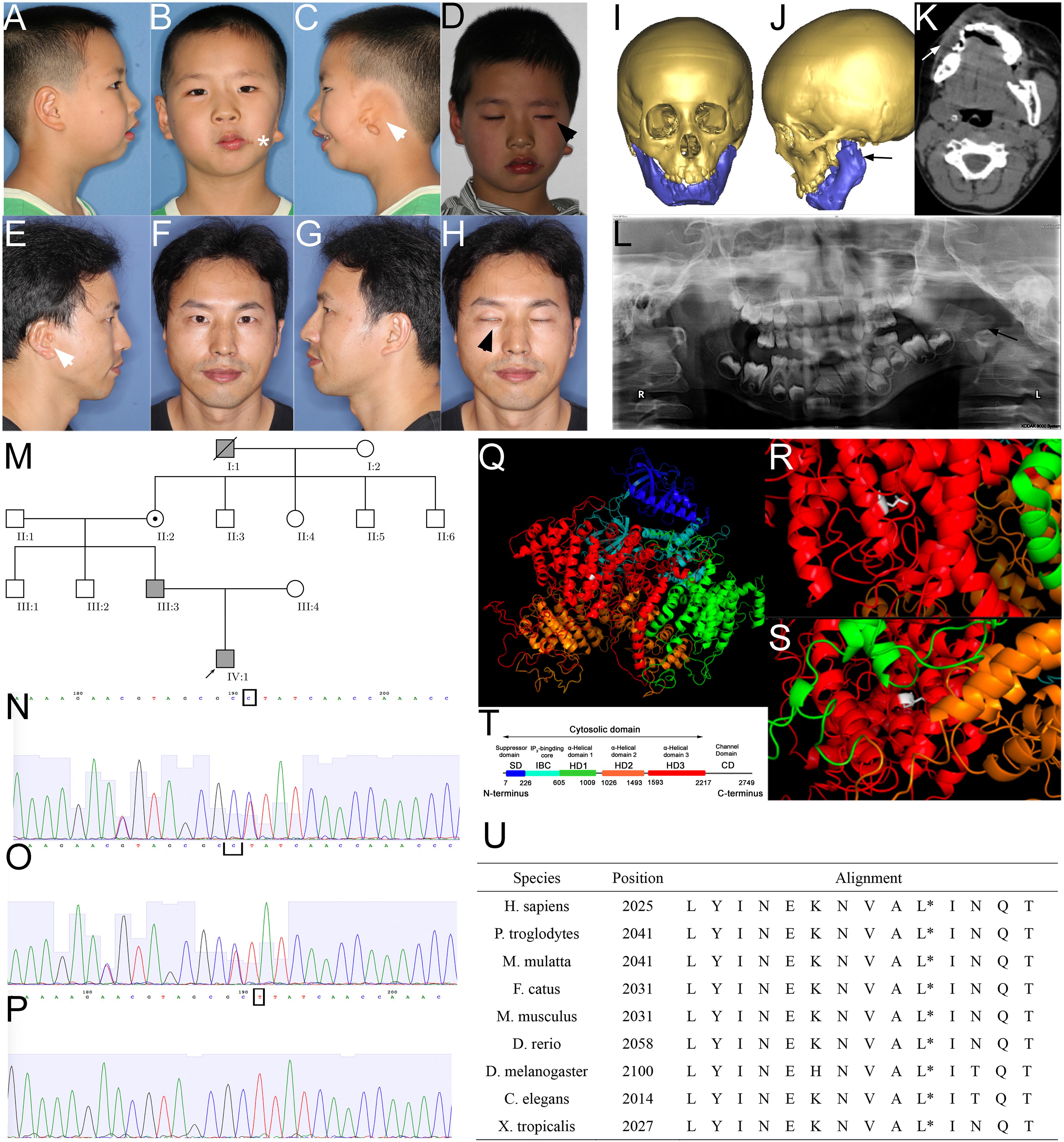 Frontiers | ITPR1 Mutation Contributes to Hemifacial Microsomia