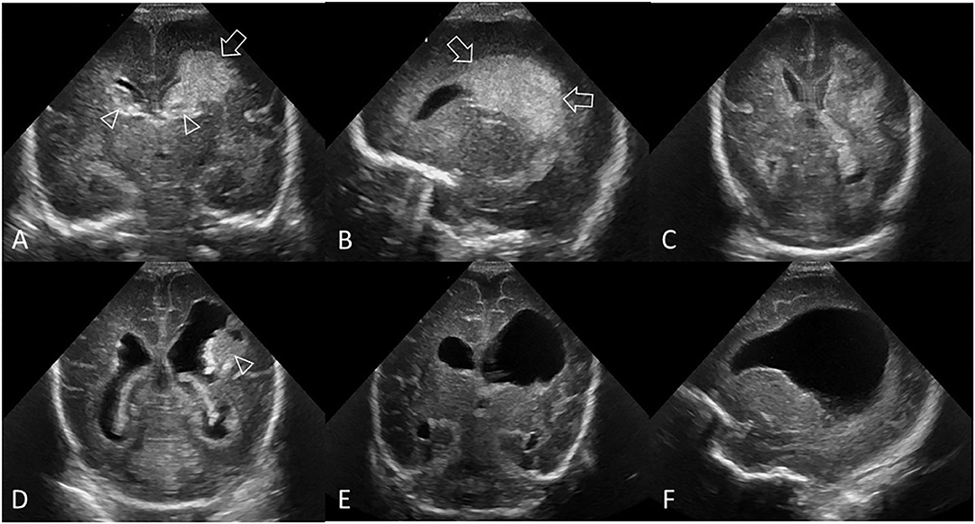 Normal Neonatal Head Ultrasound