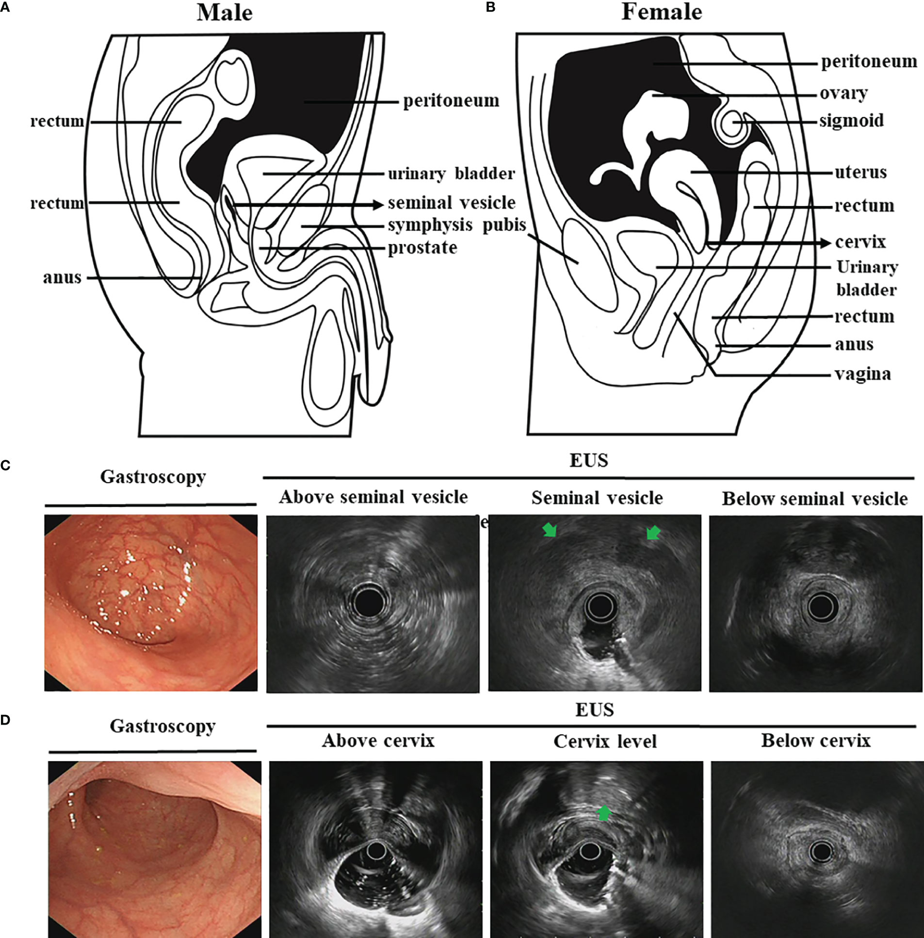 endoscopy for colon cancer