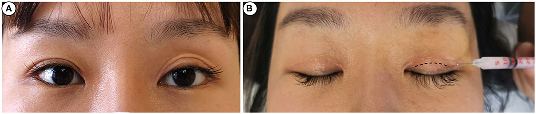 Frontiers Management of Unsatisfactory Postoperative Double
